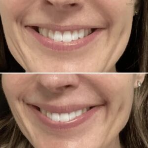 What the ‘Botox Lip Flip’ Really Looks Like Before and After | Future