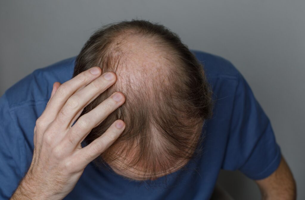 View of the top of someone's head, which is balding in the middle. Subject is a model.